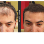Male with thinning hair, Before and After image